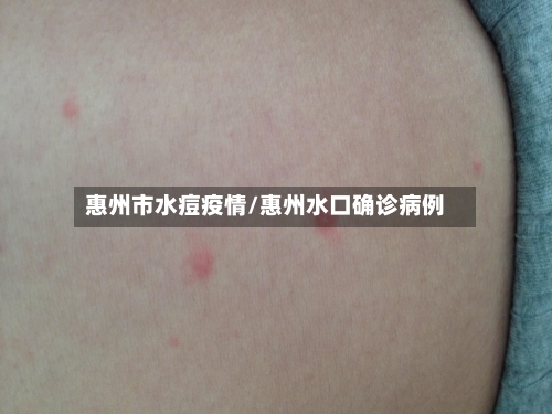惠州市水痘疫情/惠州水口确诊病例-第2张图片